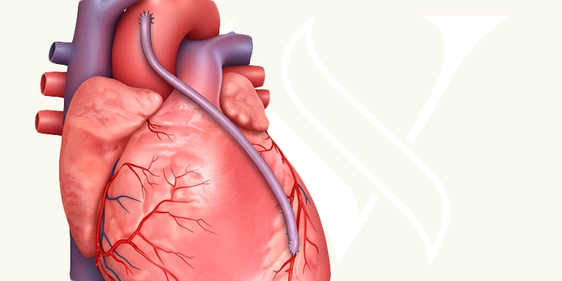 Imagem Cirurgia de Revascularização